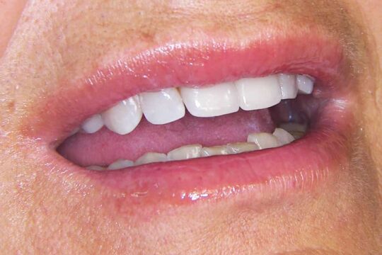 corone-integrali-01-dopo