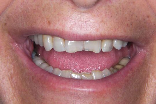 corone-integrali-01-prima