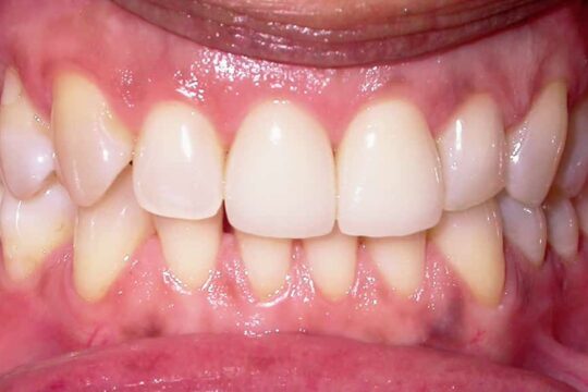 corone-integrali-02-dopo