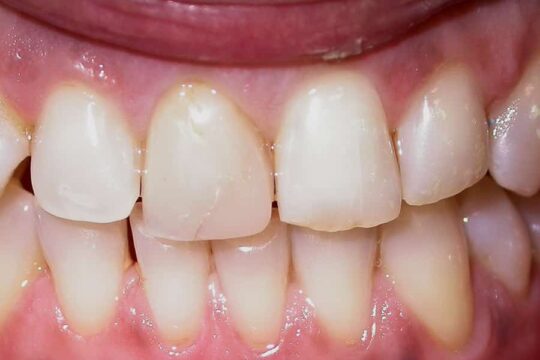 corone-integrali-02-prima