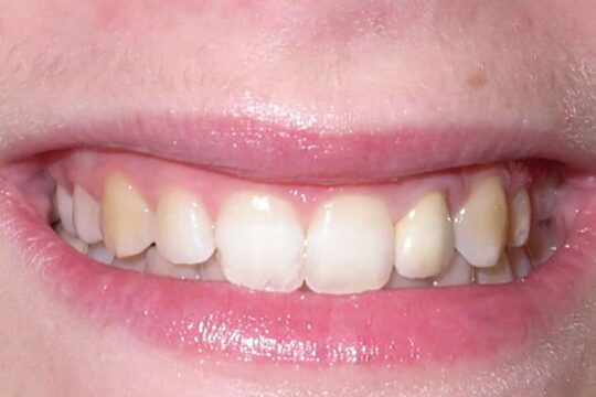 corone-integrali-03-dopo