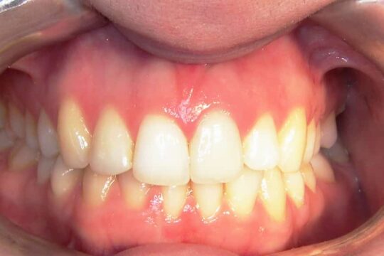 corone-integrali-04-dopo