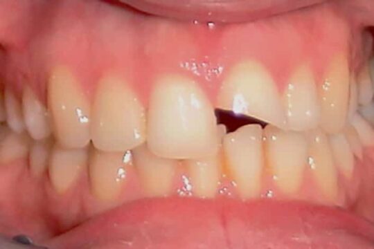 corone-integrali-04-prima