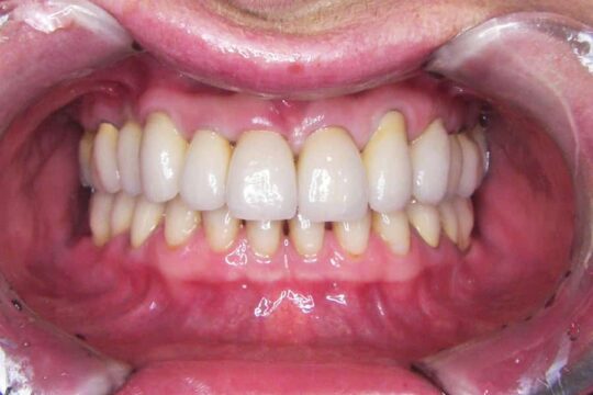 riabilitazioni-complete-06-dopo