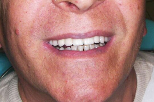 riabilitazioni-complete-08-dopo