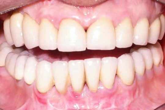 riabilitazioni-complete-05_dopo