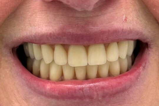 riabilitazioni-complete-09-dopo